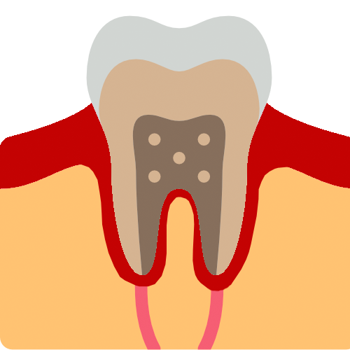 Gingivitis enefermedad periodontal