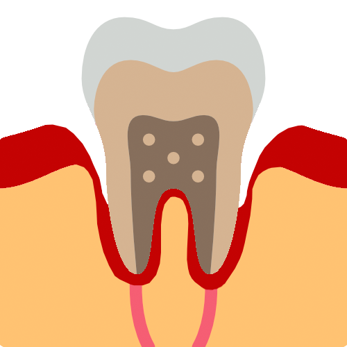 Periodontitis enfermedad periodontal